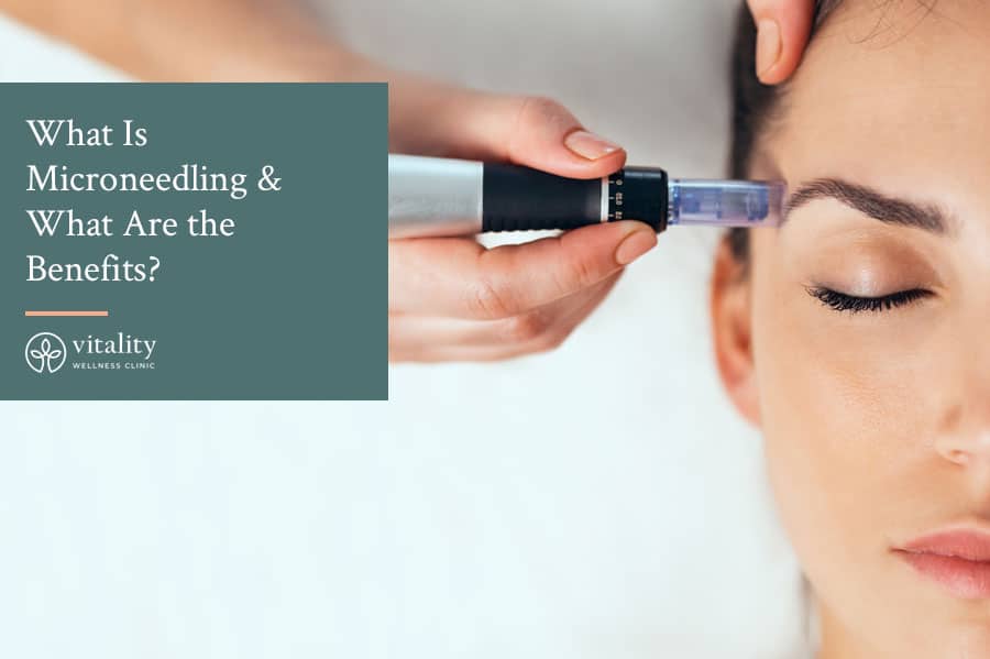 What Is Microneedling What Are The Benefits